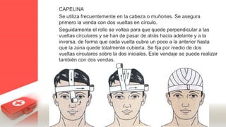 CAPELINA
Se utiliza frecuentemente en la cabeza o muñones. Se asegura
primero la venda con dos vueltas en círculo.
Seguidamente el rollo se voltea para que quede perpendicular a las
vueltas circulares y se han de pasar de atrás hacia adelante y a la
inversa, de forma que cada vuelta cubra un poco a la anterior hasta
que la zona quede totalmente cubierta. Se fija por medio de dos
vueltas circulares sobre la dos iniciales. Este vendaje se puede realizar
también con dos vendas.
 
