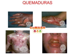 QUEMADURAS
 