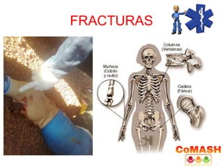 FRACTURAS
 