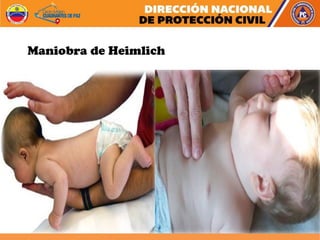 Maniobra de Heimlich
 