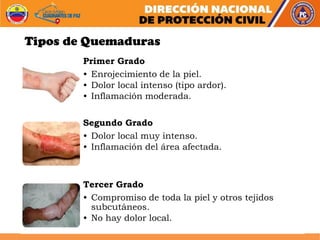 Tipos de Quemaduras
Primer Grado
• Enrojecimiento de la piel.
• Dolor local intenso (tipo ardor).
• Inflamación moderada.
Segundo Grado
• Dolor local muy intenso.
• Inflamación del área afectada.
Tercer Grado
• Compromiso de toda la piel y otros tejidos
subcutáneos.
• No hay dolor local.
 