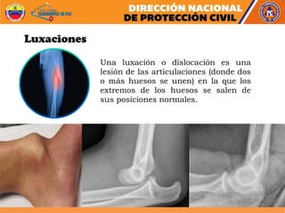 Una luxación o dislocación es una
lesión de las articulaciones (donde dos
o más huesos se unen) en la que los
extremos de los huesos se salen de
sus posiciones normales.
Luxaciones
 