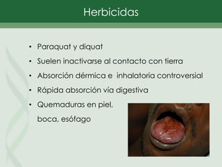 • Paraquat y diquat
• Suelen inactivarse al contacto con tierra
• Absorción dérmica e inhalatoria controversial
• Rápida absorción vía digestiva
• Quemaduras en piel,
boca, esófago
Herbicidas
 