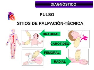 DIAGNÓSTICO

         PULSO

SITIOS DE PALPACIÓN-TÉCNICA

          BRAQUIAL


             CAROTÍDEO

           FEMORAL

               RADIAL
 