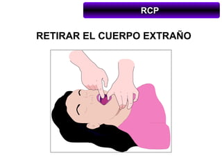 RCP

RETIRAR EL CUERPO EXTRAÑO
 