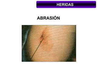 HERIDAS


ABRASIÓN
 
