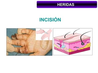 HERIDAS



INCISIÓN
 