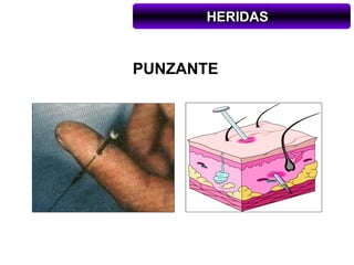 HERIDAS


PUNZANTE
 