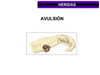 HERIDAS


AVULSIÓN
 