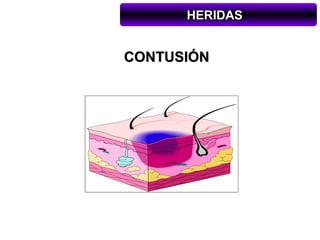 HERIDAS


CONTUSIÓN
 