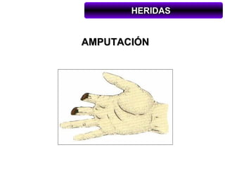 HERIDAS


AMPUTACIÓN
 