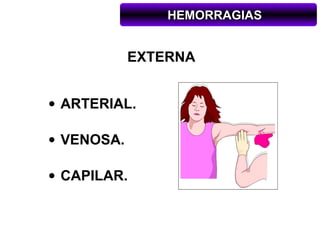 HEMORRAGIAS


            EXTERNA


• ARTERIAL.

• VENOSA.

• CAPILAR.
 