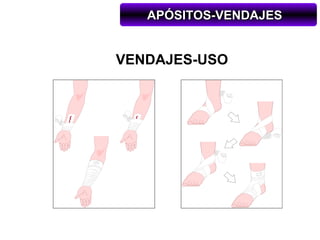 APÓSITOS-VENDAJES


VENDAJES-USO
 