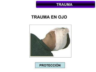 TRAUMA


TRAUMA EN OJO




  PROTECCIÓN
 