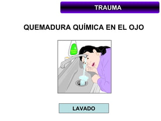 TRAUMA


QUEMADURA QUÍMICA EN EL OJO




          LAVADO
 