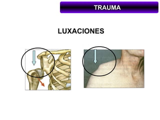 TRAUMA


LUXACIONES
 