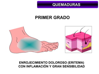 QUEMADURAS


        PRIMER GRADO




ENROJECIMIENTO DOLOROSO (ERITEMA)
CON INFLAMACIÓN Y GRAN SENSIBILIDAD
 
