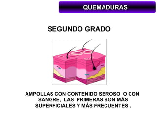 QUEMADURAS


      SEGUNDO GRADO




AMPOLLAS CON CONTENIDO SEROSO O CON
    SANGRE, LAS PRIMERAS SON MÁS
   SUPERFICIALES Y MÁS FRECUENTES .
 