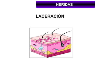 HERIDAS


LACERACIÓN
 