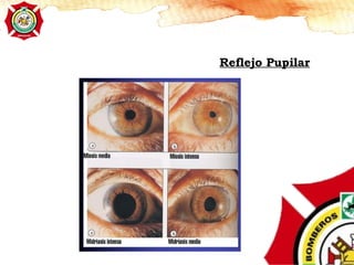 Reflejo Pupilar
 