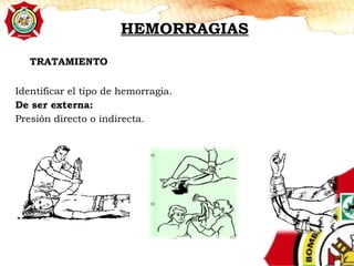 TRATAMIENTO
Identificar el tipo de hemorragia.
De ser externa:
Presión directo o indirecta.
HEMORRAGIAS
 