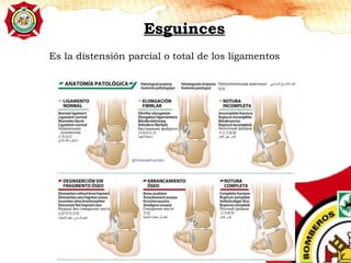 Es la distensión parcial o total de los ligamentos
Esguinces
 