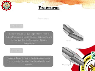 Fracturas
 