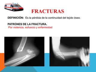 FRACTURAS
DEFINICIÓN: Es la pérdida de la continuidad del tejido óseo.
PATRONES DE LA FRACTURA.
Por violencia, esfuerzo y enfermedad
 