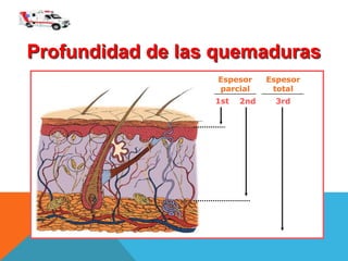 Profundidad de las quemaduras
Espesor
parcial
Espesor
total
1st 2nd 3rd
 