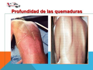 Profundidad de las quemaduras
 