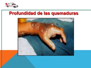 Profundidad de las quemaduras
 