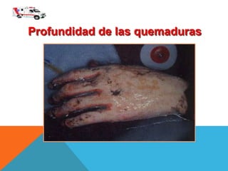 Profundidad de las quemaduras
 
