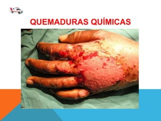 QUEMADURAS QUÍMICAS
 