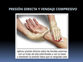PRESIÓN DIRECTA Y VENDAJE COMPRESIVO
 