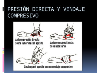 PRESIÓN DIRECTA Y VENDAJE
COMPRESIVO
 