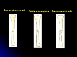 Fractura espiroidea Fractura conminutaFractura transversal
 
