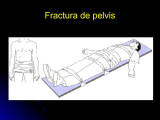 Fractura de pelvis
 