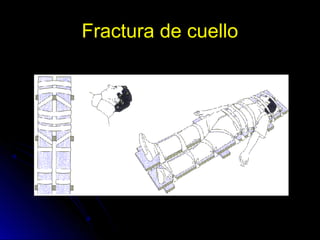 Fractura de cuelloFractura de cuello
 