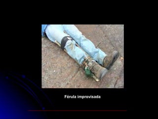 Férula improvisada
 