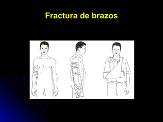 Fractura de brazosFractura de brazos
 