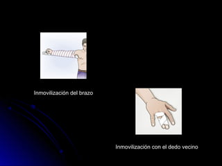 Inmovilización con el dedo vecino
Inmovilización del brazo
 