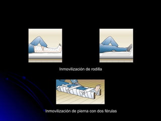 Inmovilización de rodilla
Inmovilización de pierna con dos férulas
 