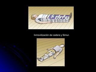 Inmovilización de cadera y fémur.
 