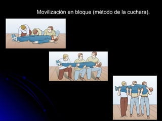 Movilización en bloque (método de la cuchara).
 