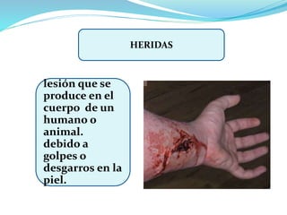 HERIDAS
lesión que se
produce en el
cuerpo de un
humano o
animal.
debido a
golpes o
desgarros en la
piel.
 