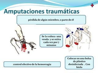 Amputaciones traumáticas
pérdida de algún miembro, o parte de él,
control efectivo de la hemorragia
Se Le coloca una
venda y se retira
cada vez por 7
minutos
Colocar en una bolsa
de plástico
desinfectada . Con
hielo
 