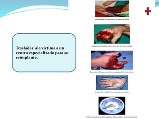 Trasladar ala victima a un
centro especializado para su
reimplante.
 