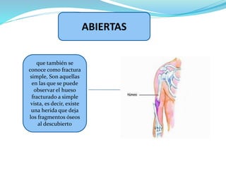 ABIERTAS
que también se
conoce como fractura
simple, Son aquellas
en las que se puede
observar el hueso
fracturado a simple
vista, es decir, existe
una herida que deja
los fragmentos óseos
al descubierto
 