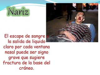 El escape de sangre o
la salida de liquido
claro por cada ventana
nasal puede ser signo
grave que sugiere
fractura de la base del
cráneo.
 