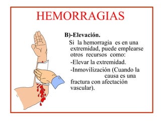 HEMORRAGIAS
B)-Elevación.
Si la hemorragia es en una
extremidad, puede emplearse
otros recursos como:
-Elevar la extremidad.
-Inmovilización (Cuando la
causa es una
fractura con afectación
vascular).
 